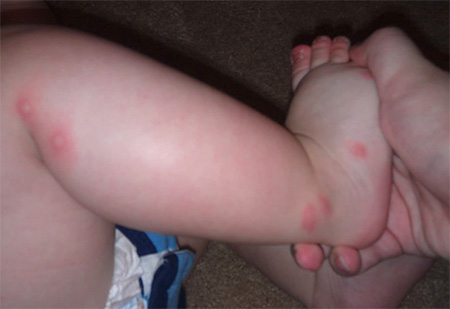 Morsi di cimici sulla gamba di un bambino