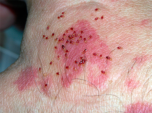 Larve di cimici sulla pelle