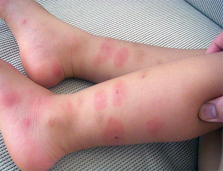 Δαγκώματα κοριού στα πόδια του παιδιού