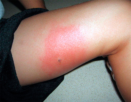 Allergi mot insektsstick