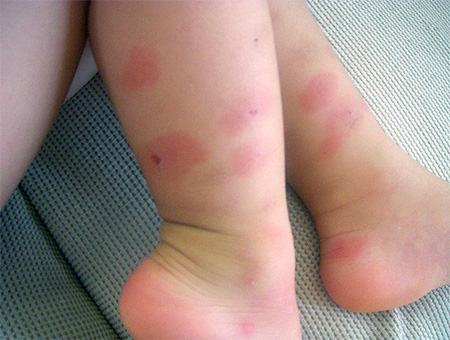 Αλλεργία στο δάγκωμα ζωύφιου