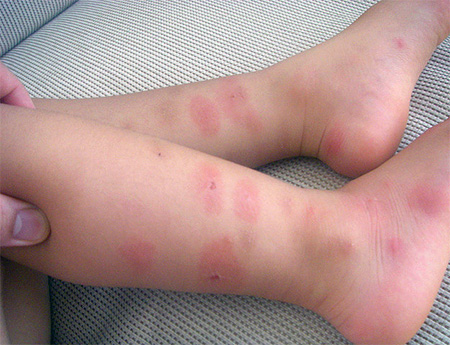 Reazione allergica in un bambino alle punture di cimici