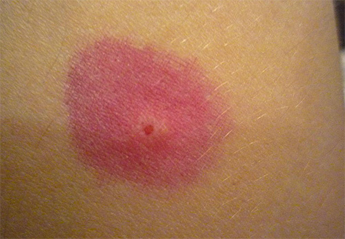 Bir pire ısırığına karşı hafif bir alerjik reaksiyon örneği