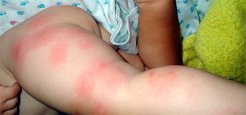 Ett exempel på allergi mot loppbett