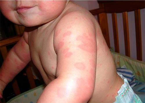 Primjer alergije kod djeteta na ugrize stjenica
