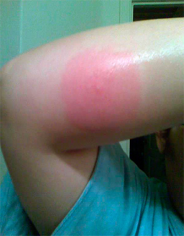 Foto: o reacție alergică la o mușcătură de purici