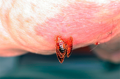 Banyak gigitan bedbug boleh menyebabkan reaksi alahan yang teruk pada badan.