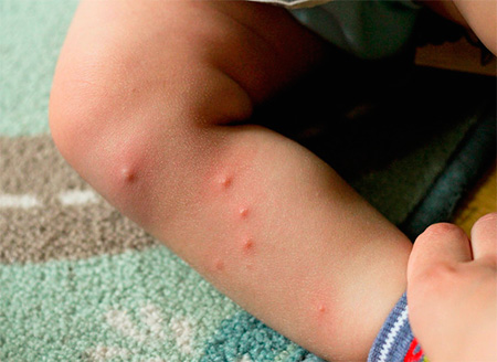 Vlooienbeten op het been van een kind