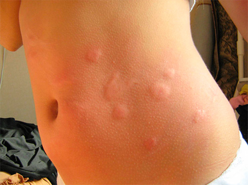 Φωτογραφία: δαγκώματα ψύλλων στο σώμα ενός παιδιού