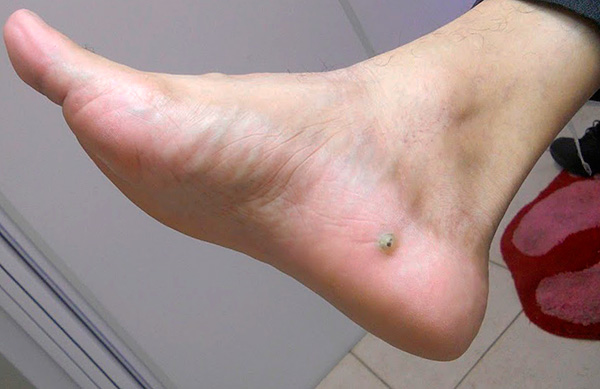 De wond op het been is een zandvlo (ook wel grondvlo genoemd) onder de huid.
