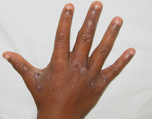 يعتبر البنزيل بنزوات أكثر فاعلية في علاج الجرب الناجم عن عث الجرب تحت الجلد.