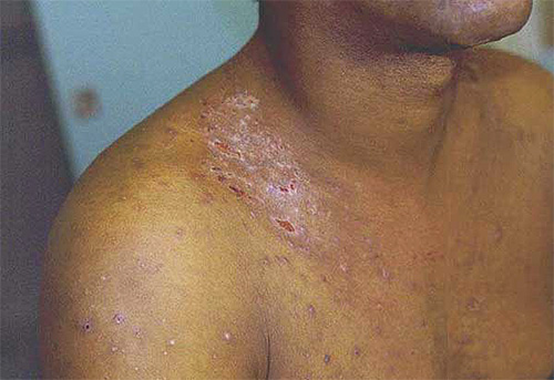 Fotografia prezintă un exemplu de manifestare a febrei Volyn