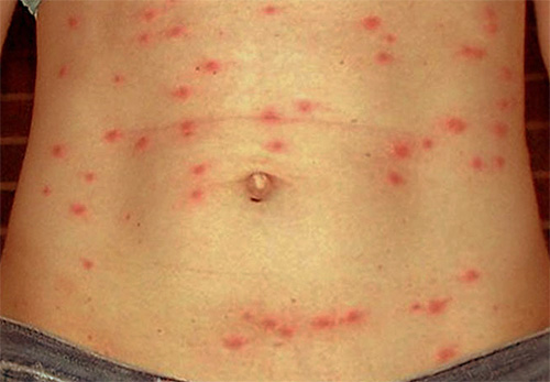 Kutu adalah pembawa typhus, salah satu simptomnya ialah ruam pada badan.