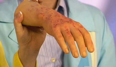 Segni di tifo sulla pelle della mano