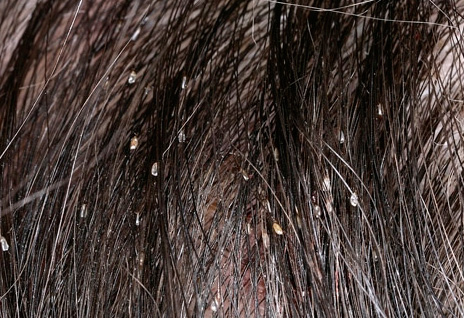 Sebagai peraturan, nits pada rambut bukanlah agen jangkitan utama.