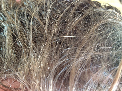 Ecco come appaiono i capelli quando la testa è fortemente infestata dai pidocchi