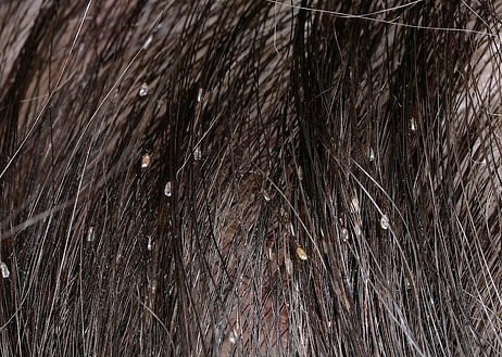 مع وجود عدد كبير من الصئبان في الشعر ، فإنها تشبه إلى حد ما قشرة الرأس