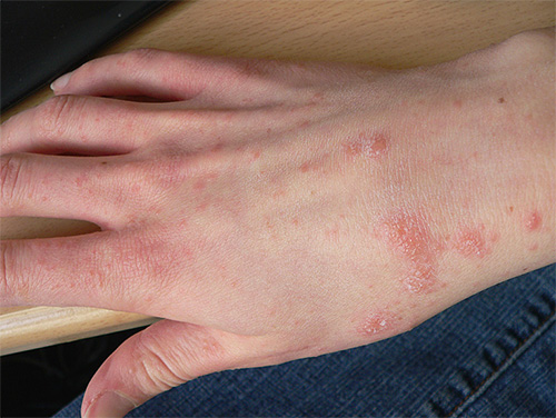 Eruzione cutanea sulla pelle delle mani con scabbia