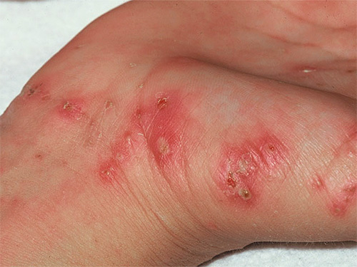 Hama kudis menyebabkan kegatalan teruk pada kulit yang sama seperti kutu