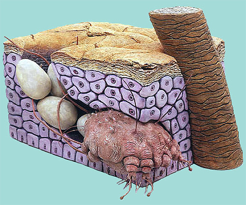 Căpușa femela și ouăle ei în grosimea pielii