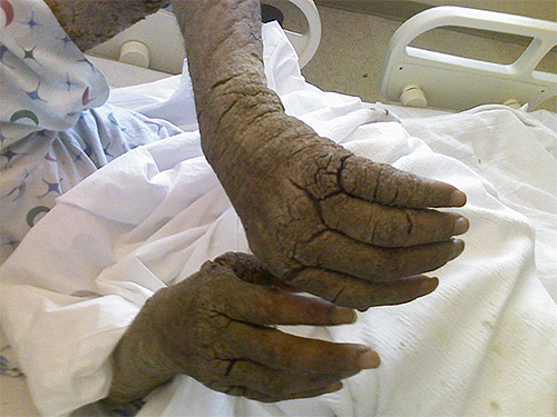 Fénykép emberi kézről norvég rühvel