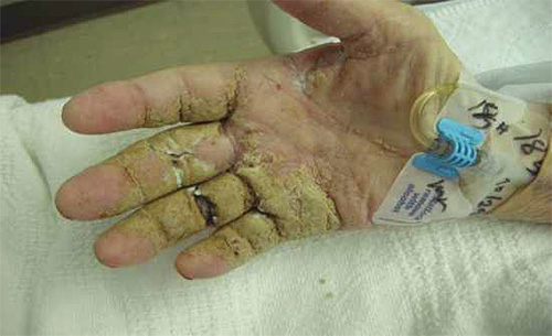 มือของคนที่มีอาการหิดนอร์เวย์