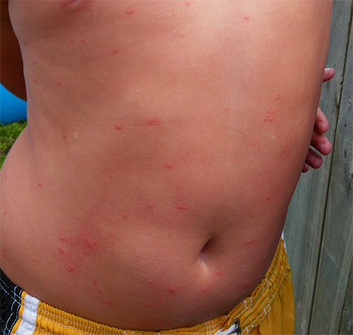 Linnelöss infekterar delar av kroppen som är dolda av kläder, till skillnad från till exempel myggor