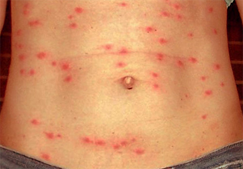 Manifestaties van tyfus op de huid van de buik