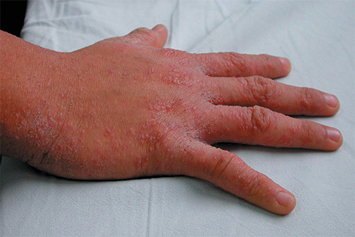 På bilden - manifestationer av skabb på handens hud