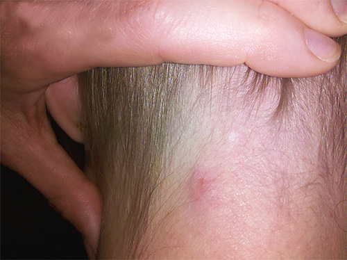 Sebbene i pidocchi non possano vivere sotto la pelle, possono causare morsi e irritazioni.