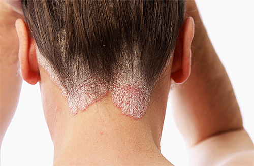 قد تظهر أعراض مرض الصدفية الجلدي على خلفية التجارب القوية.