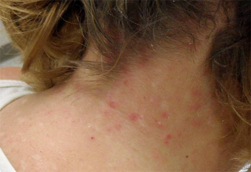 Antara manifestasi pedikulosis pada kanak-kanak, tempat utama diduduki oleh gigitan kutu di leher dan kepala, yang mungkin disertai dengan reaksi alergi.