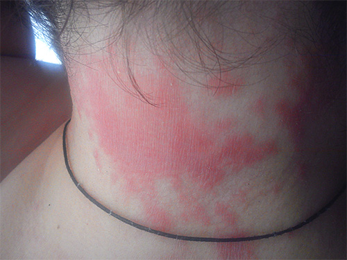 Dengan kecenderungan untuk alergi, penggunaan Nyx boleh menyebabkan ruam pada leher dan kulit kepala