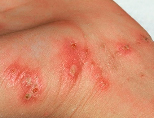 Lesioni cutanee causate dalla scabbia