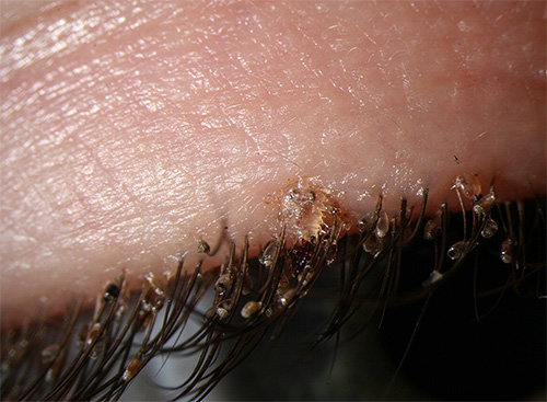 Ηβικές ψείρες και οι κόνιδες τους στις ανθρώπινες βλεφαρίδες
