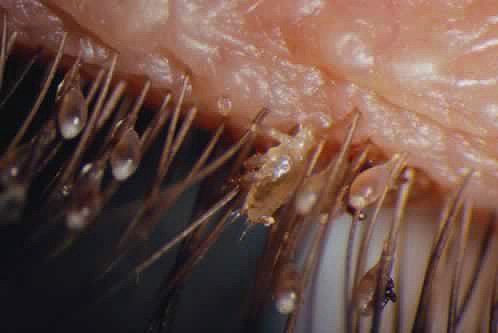 อีกรูปของ pubic lice และ nits บนขนตา