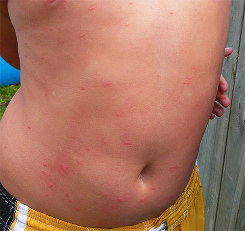 Linnelusbett kan åtföljas av allergiska utslag.