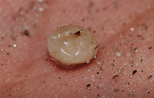 Fotoğrafta - ısırık bölgesinde derinin altından çıkarılan bir dişi kum piresi