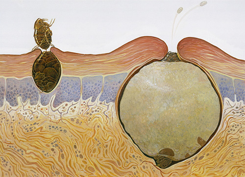 De afbeelding laat zien hoe de vrouwelijke zandvlo zich gedraagt ​​in het menselijk lichaam.