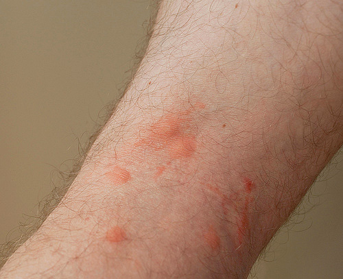 Vlooienbeten kunnen niet alleen beladen zijn met allergische huiduitslag, maar ook met lokale ettering