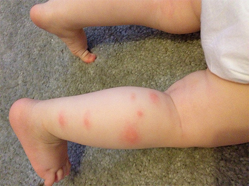 Morsi di pulci sulla gamba di un bambino