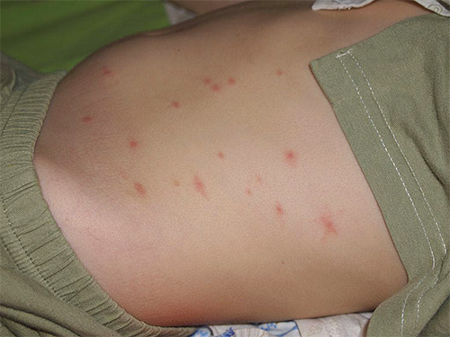 Una reazione allergica in un bambino a un morso di pulce può essere molto più pronunciata che in un adulto.