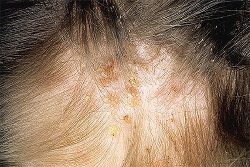 A kátrányszappant régóta használják bőrbetegségek, köztük a tetvek okozta betegségek ellen.