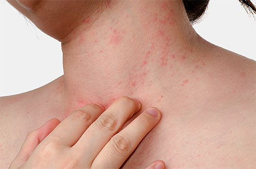 الطفح الجلدي على الجسم هو مجرد واحدة من العواقب التي تهدد عند محاولة إزالة القمل باستخدام ديكلوروفوس