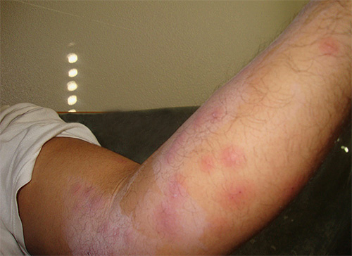 Bir apartman dairesindeki ilk tahtakurusu ısırıkları genellikle sivrisinek ısırıkları veya alerjilerle karıştırılır.