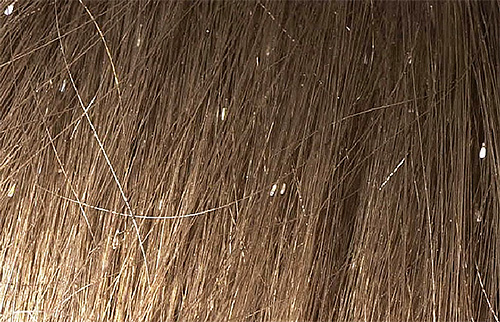 Neten in het haar - een kenmerkend symptoom van een besmetting met hoofdluis
