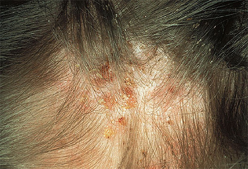 Vid ett kraftigt lusangrepp liknar symtomen de som uppstår vid dermatit.