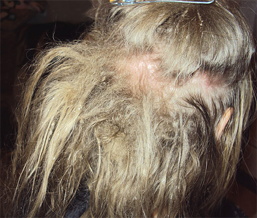 De aanwezigheid van luizen in het haar wordt ook aangegeven door een teken als klitten.