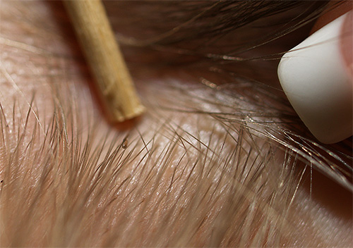 Om du sprider håret med fingrar eller pincett kan du tydligt se nötterna och själva lössen