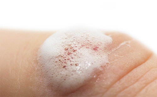 Οι θεραπείες για τις ψείρες όπως το υπεροξείδιο του υδρογόνου μπορούν να έχουν ισχυρή επίδραση όχι μόνο στα παράσιτα, αλλά και στο ανθρώπινο δέρμα.